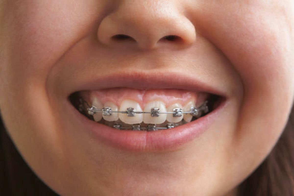 What is Two-Phase Orthodontic Treatment?
